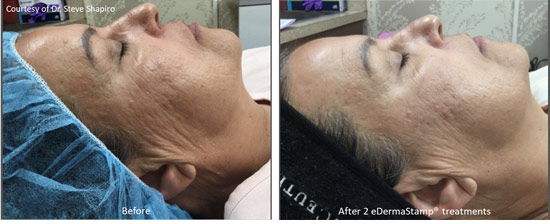 Before and after microneedling result image
