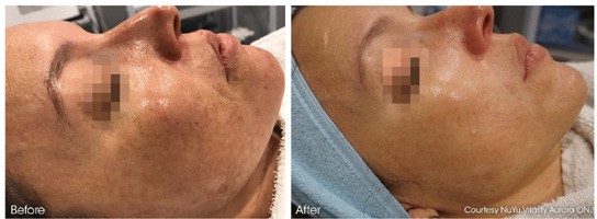 Before and after skin clarity result image