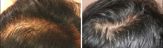 Before and after scalp support result image