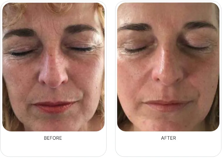 OxyGeneo before-and-after facial result image from the partner page