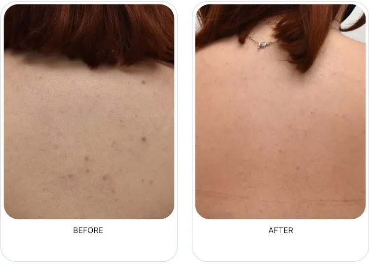 OxyGeneo treatment result image from the partner page